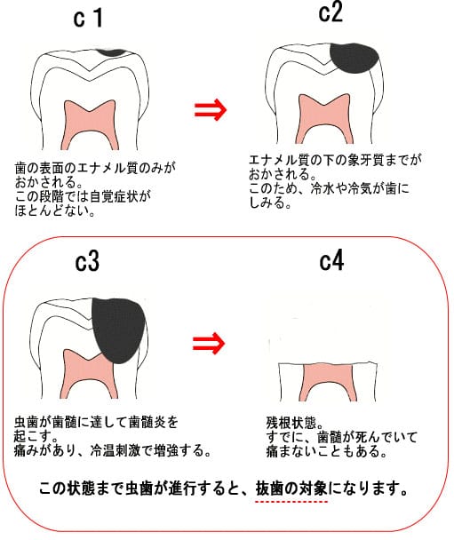 虫歯の進行