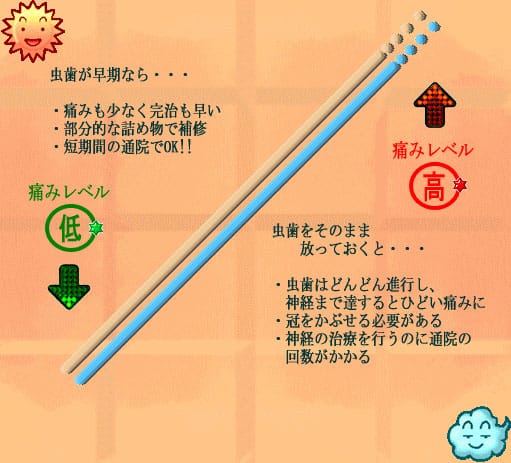 虫歯の進行